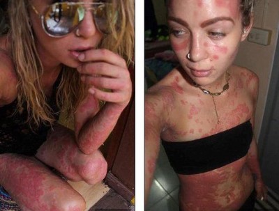 Селфи псориаз