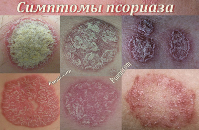 Первые симптомы псориаза