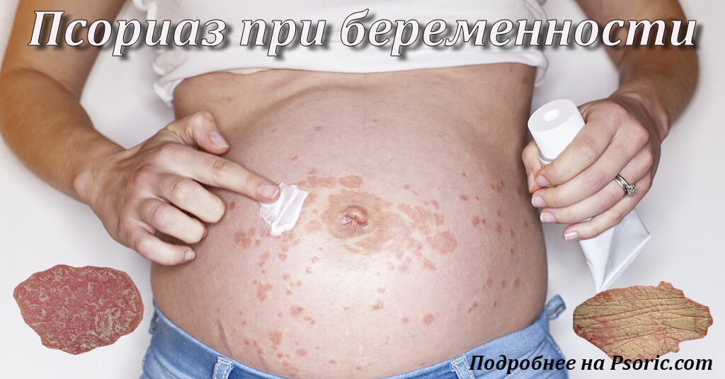 Псориаз и беременность