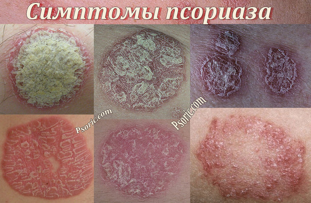 псориаз в начальной стадии