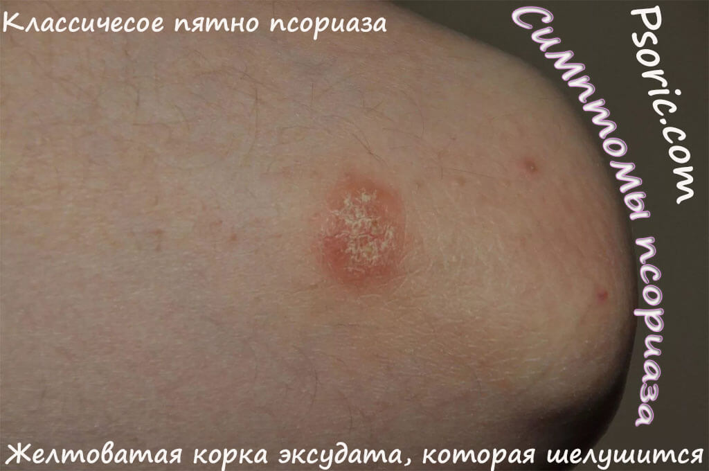 Симптомы начального псориаза