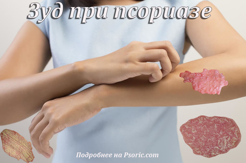 Зуд при псориазе
